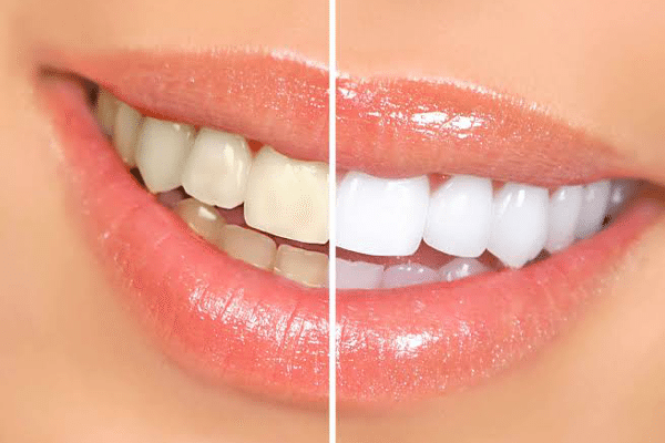 Before and after image of teeth after teeth whitening