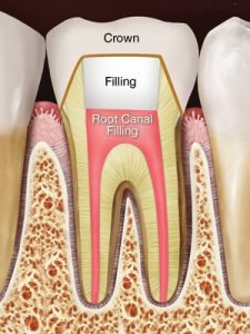 root canal treatment filling and crown