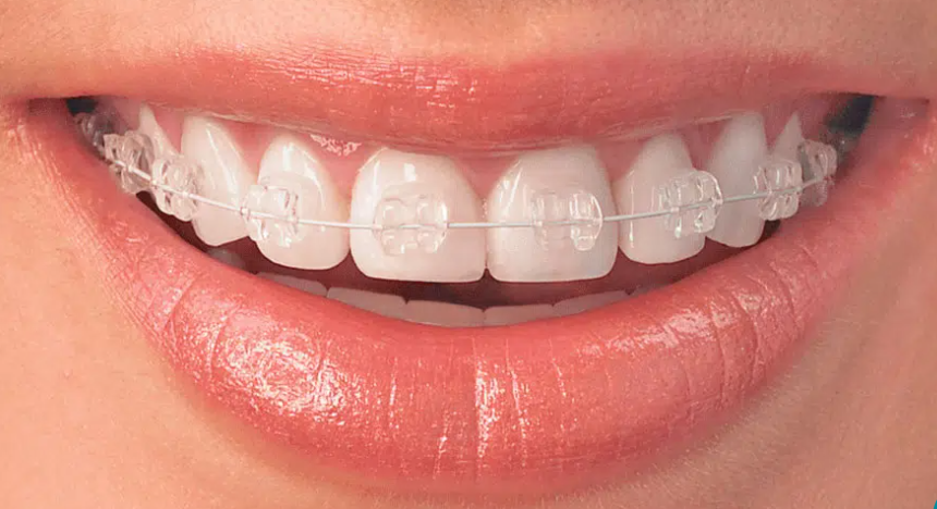 Best metal and ceramic braces in Sinhagad Road Pune
