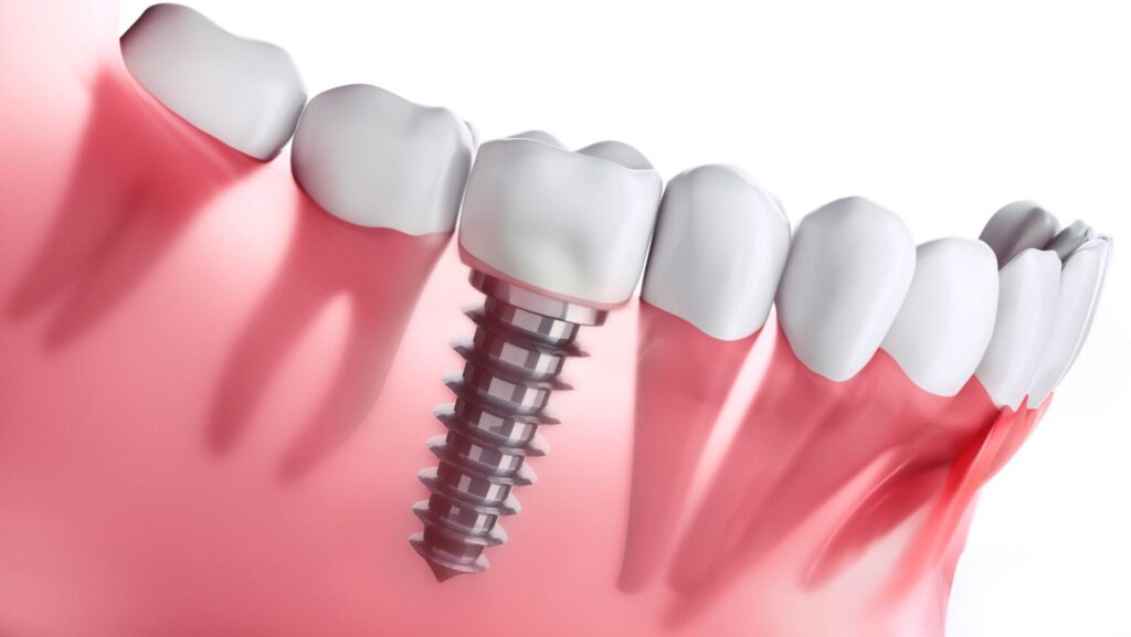 Dental-implants-in-sinhagad-road-pune