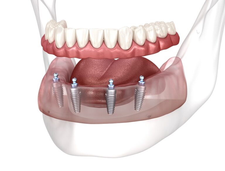 Price of Implant Overdenture in Pune