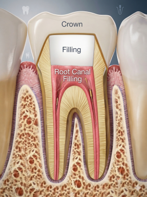 root-canal-filling-in-pune